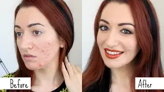 Easy Acne & Scarring Coverage GRWM // How To Cover Acne Makeup Transformation