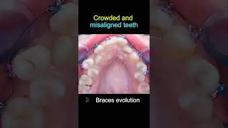 Braces for crowded and misaligned teeth #braces #dentist #orthodontist