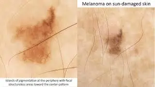 The power of the CASIO DZ-D100 camera - 13. Melanoma on sundamaged skin