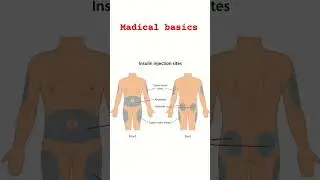 site's of insulin injections #injection #insulin #education #madical #madico