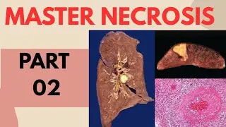 Necrosis Part 2 #pathology #medicallectures #studywithme #generalpathology #biology #mustwatch #fyp