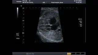TOSHIBA APLIO-80 (2003)  #4 CHAMBER AXIAL VIEW #(FETAL ECHOCARDİOGRAPHY)