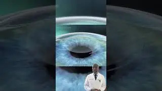 The Surprising Truth About Fast Recovery with SMILE Flapless LASIK Nobody Tells You