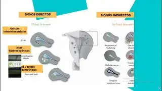 Adenomiosis Implicancias en la Fertilidad y la Reproducción Asistida  III SC SPUOG 150725