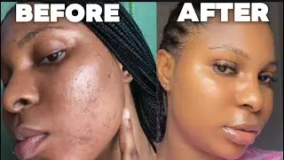 I Got Smooth Skin In Weeks : Here&rsquo;s My Exact Routine 
