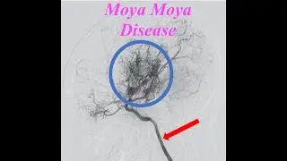 Radiology of Moyamoya Disease