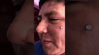 Resultado microdermal p&oacute;mulo #piercing #bodymodifications