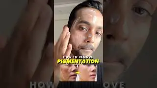 How to Remove Pigmentation FAST! 🧴 Best Home Remedies & Skincare Tips for Clear Skin #shorts