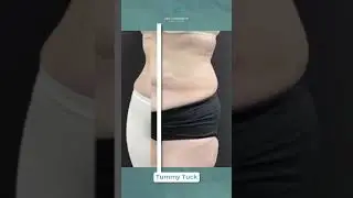 Check out Dr. LaBarbera&rsquo;s Tummy Tuck transformation #tummytuckbeforeandafter