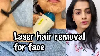 LASER HAIR REMOVAL FACE | My Experience of Facial Laser Hair Removal | Laser Hair Removal in India