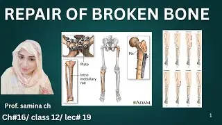 Repair of a Broken Bone &ndash; Healing Process Explained