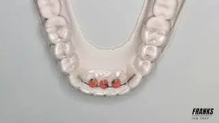Bonded Retainer Demo with Indirect Bonding by @AltaSmiles