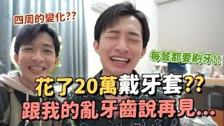 我開始戴牙套了！隱形牙套的優缺點？總共要戴多久？需要的程序有哪些～我的牙套日記