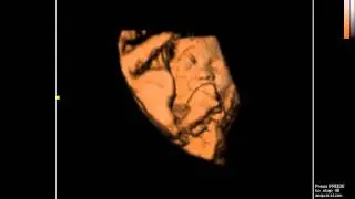 Color Doppler Ultrasound Sonoscape S8 | Demo of 4D Function