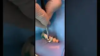 Composite veneers #dentist #teethrestoration