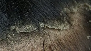 ASMR Satisfying Dandruff Treatment & Scalp Check #35