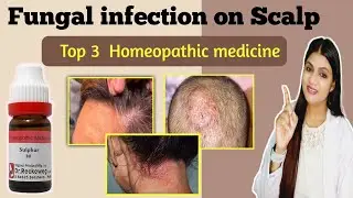 top 3 homeopathic medicine for fungal infection on scalp | head Fungus | tinea capitis homeopathy