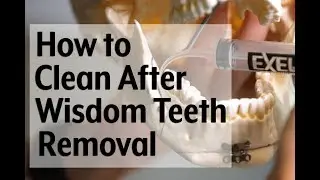 Post-op video instruction: How to clean with a syringe after wisdom teeth removal