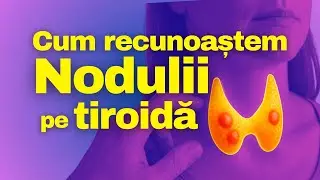 Nodulii pe TIROIDĂ: cum îi recunoaștem și când e CANCER