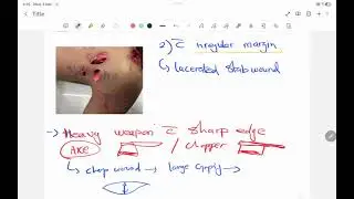 Injury ||  type of injury || incised wound lacerated wound stab wound  || fmt || forensic medicine