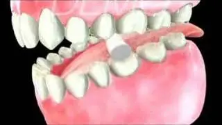 Root Canal-Dental