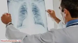 СИМПТОМЫ МЕЗОТЕЛИОМЫ - КАК ДИАГНОСТИРУЕТСЯ МЕЗОТЕЛИОМА?...