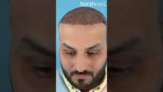 Hair Transplant in Dubai | Best Hair Transplant Clinic | Bizrahmed