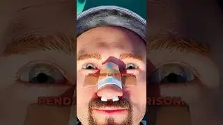 Comment r&eacute;parer un nez cass&eacute; 👃😳