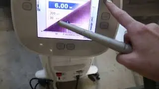 2011 Syneron Litetouch TLA5405