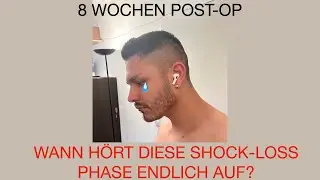 Barthaartransplantation noch immer in der Shock-Loss Phase!? - 2 Monate Post-OP
