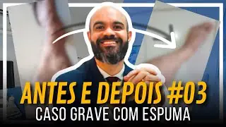 ♻️ Caso grave de Varizes GROSSAS feito com ESPUMA!! [ANTES e DEPOIS 03] #vidasemvarizes