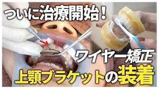 【ワイヤー矯正】上顎のブラケット装着に密着！ 【名古屋茶屋歯科・矯正歯科】