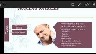 What is Torticollis(Wry Neck) Twisted Neck