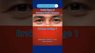 A wrinkle on the nose bridge can be a sign of heart problems? #JinBodhiPhysiognomy #heartdisease