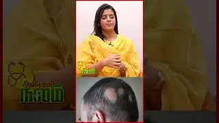 Solution for Alopecia Areata | DR.Poornima | PT Prime