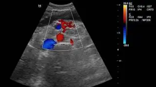 CASE 271 SUPERIOR MESENTERIC ARTERY SYNDROME  SMAS