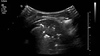 dynamic air bronchogram 2