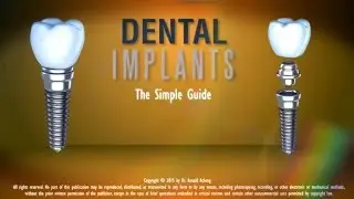 Dental Implants - An Easy Fix for Missing Teeth in Central Flordia