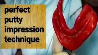 Perfect Putty Impression for Edentulous Patient  | Complete Denture Impression Technique