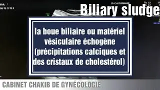 Biliary sludge // Dr C A DJENNANE