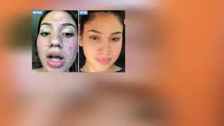 BREYLEE Acne Treatment Serum