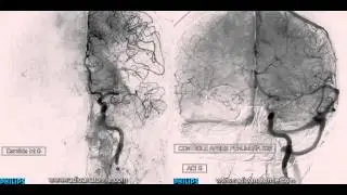 Angiographie c&eacute;r&eacute;brale avant et apr&egrave;s thrombectomie