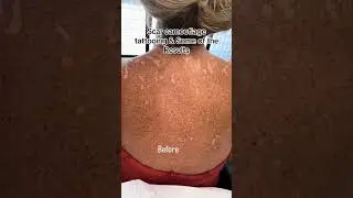 Amazing Before and After Scar Tattoo Results!