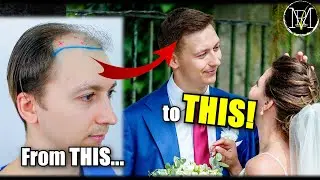Hairline Upgrade for the Big Day!