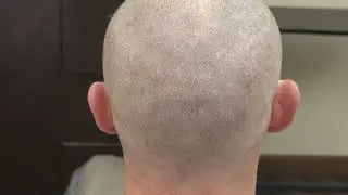 FUE Hair Transplant Scar Explained by Dr. Diep | Manual vs FUT & Natural Healing