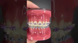 Different Types of Orthodontic Ties you can get at your Orthodontist Part 2