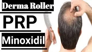 जानिए गंजेपन Baldness Hairfall & Hair Thinning में  Prp, Minoxidil & Derma Roller का results |