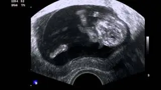 Unsere MiniRobbe in der 12. SSW 1. Video