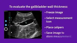 Vscan Air&trade; | Using presets for evaluations: gallbladder