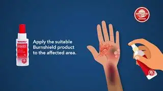 The Treatment of Burns with Burnshield